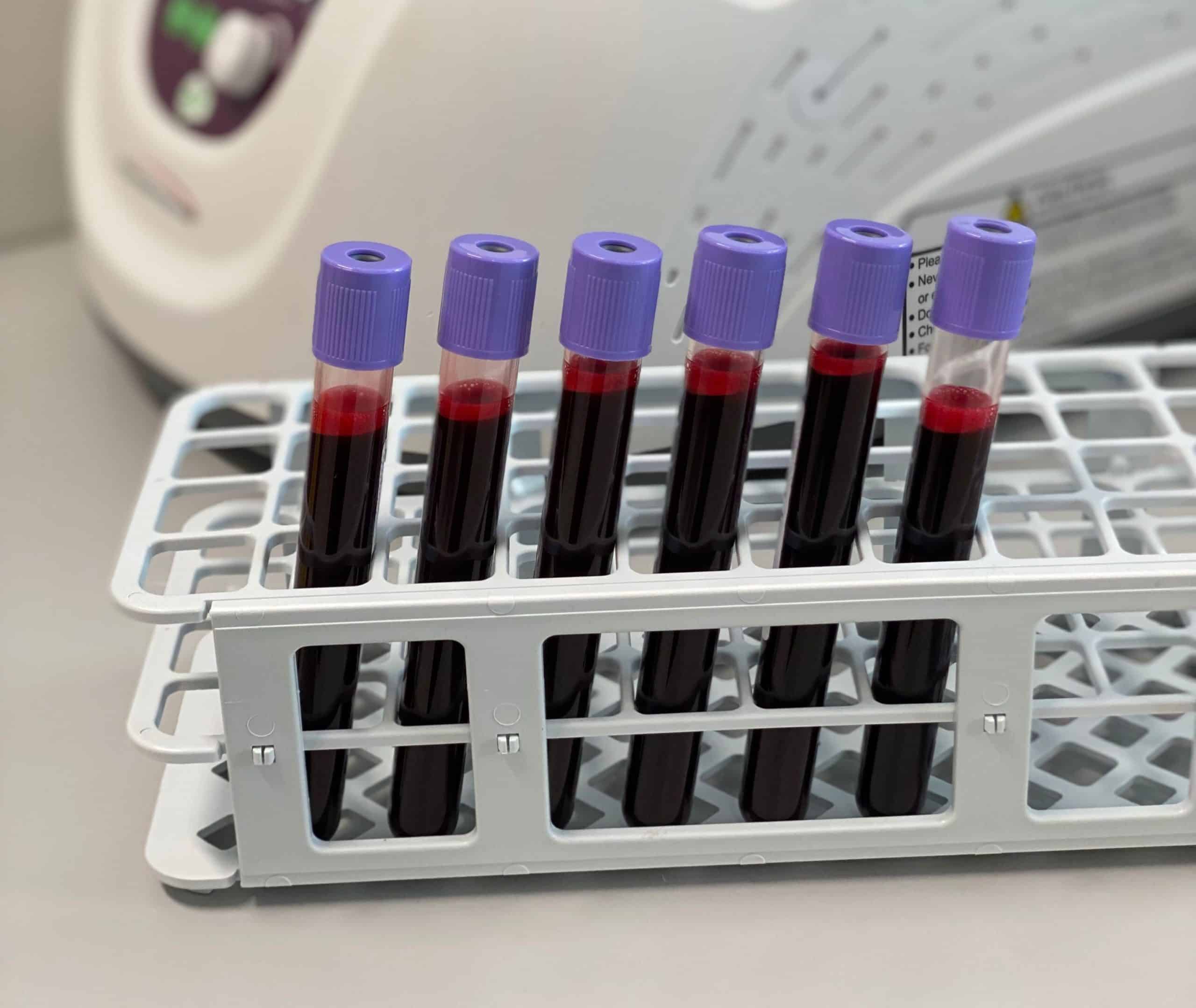 Bilde av seks blodprøver i glass med lilla lokk som står i en beholder ved siden av sentrifugemaskinen. Over alt blodet i prøveglassene ser man en lysere rød, konsentrert væske, som er stamcellene - Stamcelleklinikken - Artrose
