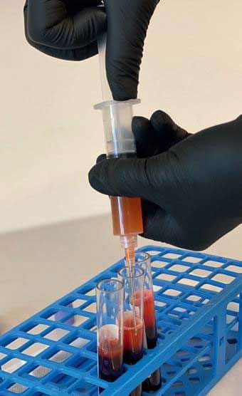 Blodprøver på Stamcelleklinikken brukt til stamcellebehandling